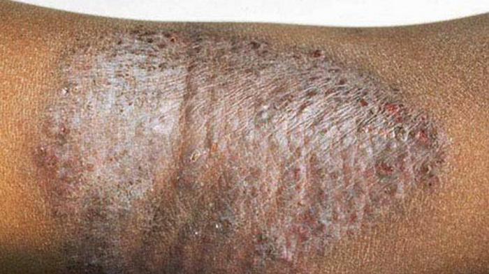 penyebab penyakit kulit eksim kering