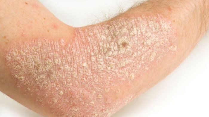 obat eksim kering yang paling mujarab